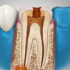 Periapical Infection